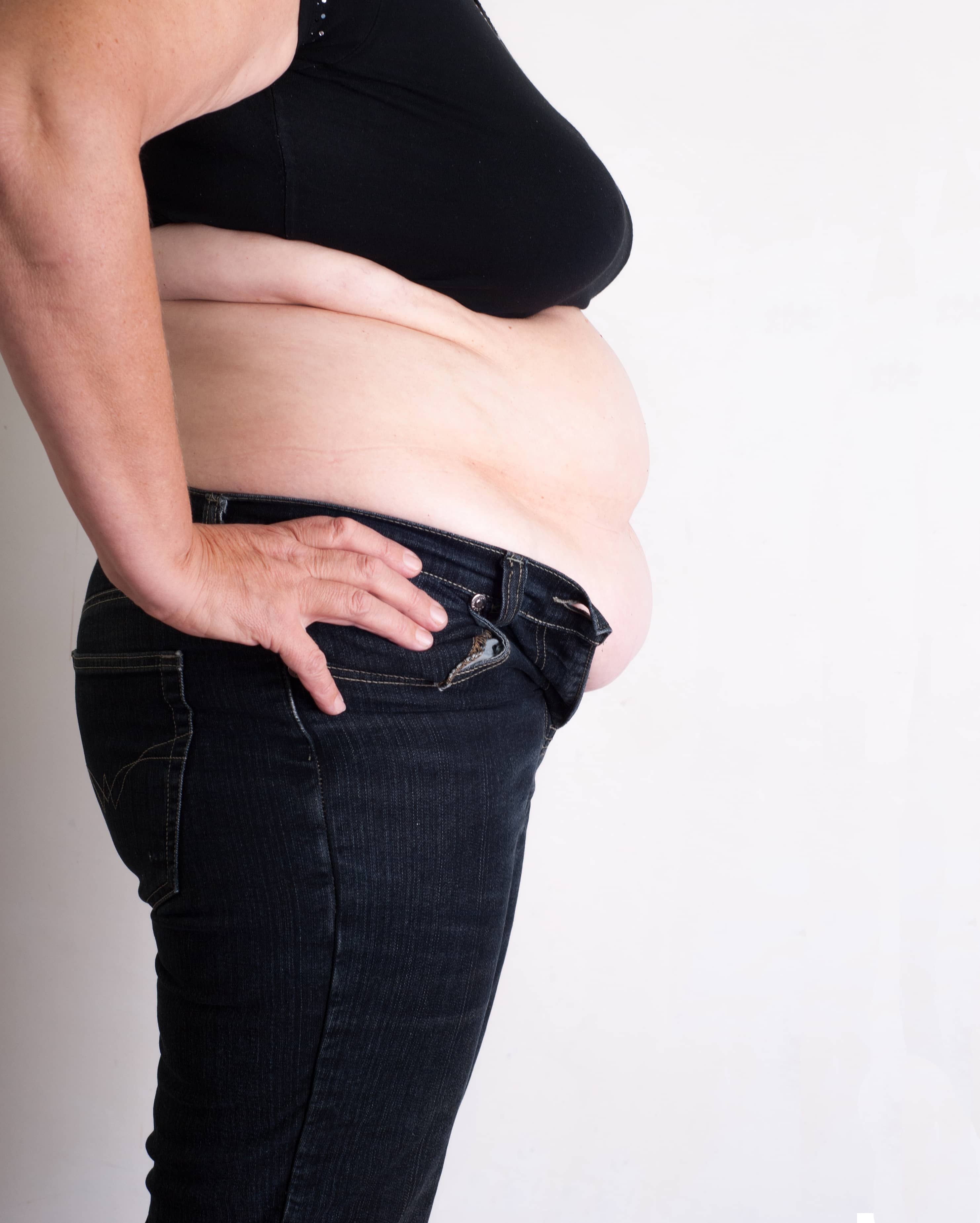 Quel est le lien entre obésité et hypertension ?